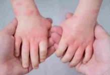 अब Tomoto Flu का कहर, ये हैं लक्षण, केंद्र ने जारी की गाइडलाइंस, tomato